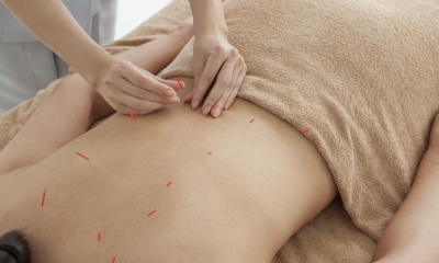 Person in brown towel lying face down receiving acupuncture on their back